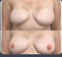 Nipple Tattoo done in karachi