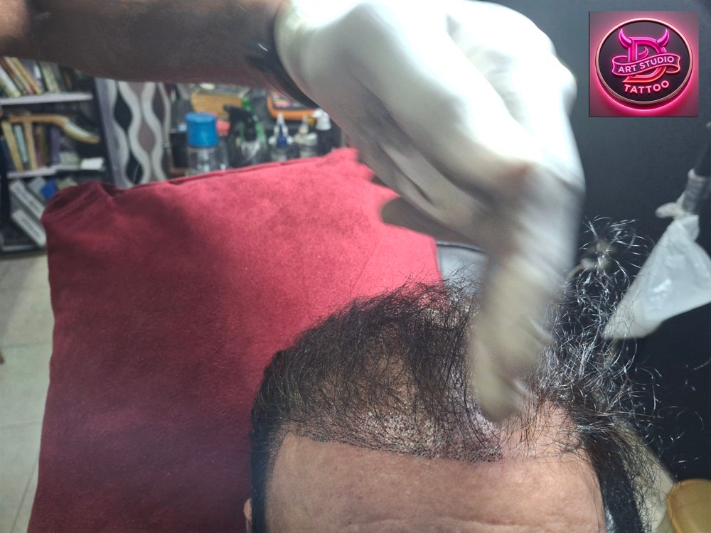 Scalp Micropigmentation SMP hairline treatment session in Karachi at Devil Art Studio Tattoo